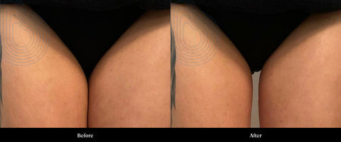 CFU Before After — Thigh Fat