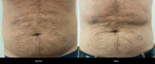 CFU Before After — Abdomen Fat