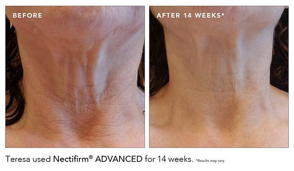 Before After Nectifirm Advanced 14 weeks