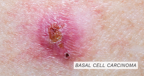 Basal Cell Carcinoma || basal cell treatment , how is basal cell carcinoma treated , most common form of skin cancer , how is skin cancer treated , signs of basal cell carcinoma , basal cell carcinoma symptoms , what does basal cell carcinoma look like