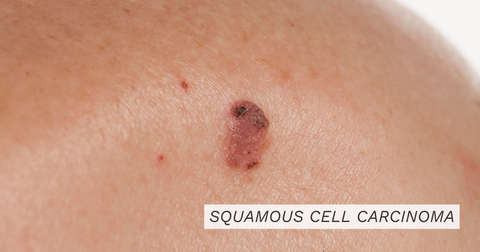 Squamous Cell Carcinoma || what is squamous cell carcinoma , squamous cell treatment , how is squamous cell carcinoma treated, signs of squamous cell carcinoma, what does squamous cell carcinoma look like , skin cancer treatment , how is skin cancer treated