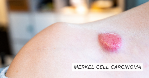 Merkel Cell Carcinoma || what is merkel cell carcinoma , rare types of skin cancer, rare types of cancer , does merkel cell cancer spread , signs of merkel cell carcinoma , what does merkel cell carcinoma look like , how is merkel cell carcinoma treated , merkel cell carcinoma treatment , radiation therapy skin cancer , chemotherapy skin cancer , skin cancer what to look for