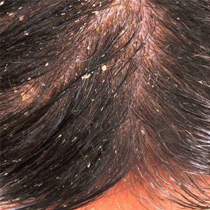 Get Rid of Dandruff