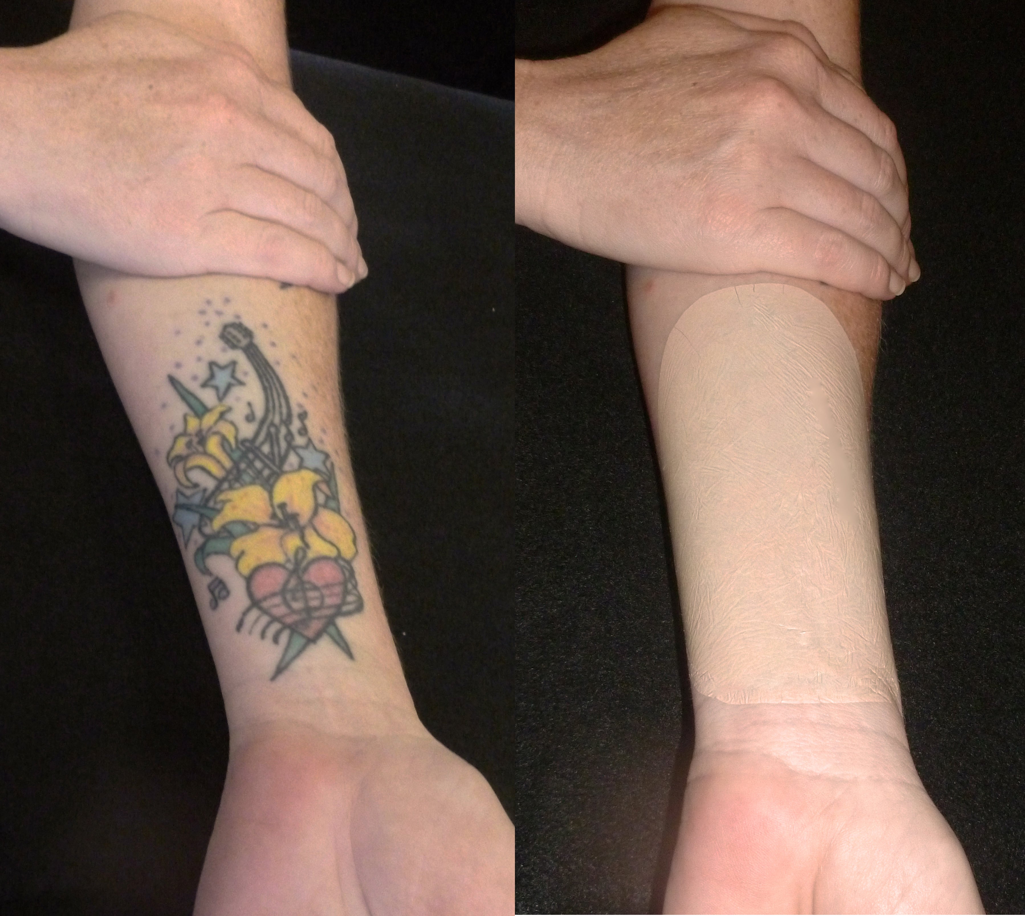 18 Tattoo CoverUp BeforeAndAfter Pics