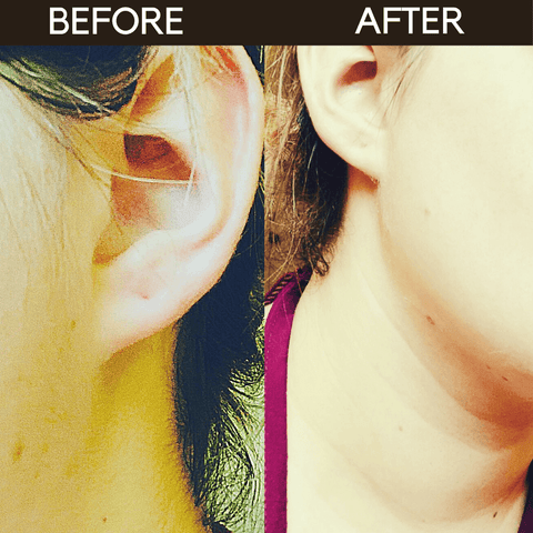 Dermaplaning before and after