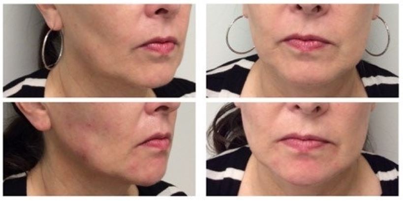 Dr. Bindiya - Chiseled jawline? Yes, please! As we age the face grows  forward and starts to sag. We've started to see a lot of younger women  among the older women concerned