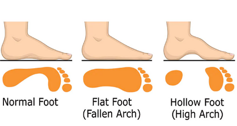 Foot arch picture