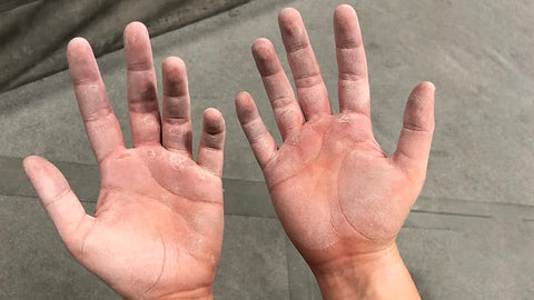 Climber Injured Hand