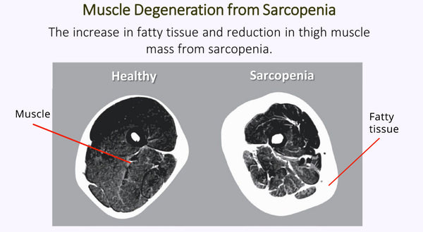 Muscle-Degeneration-from-Sarcopenia