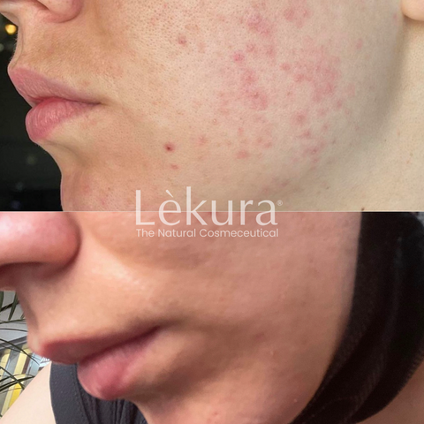 Before & After Image from mask related breakouts with a purifying homecare routine.