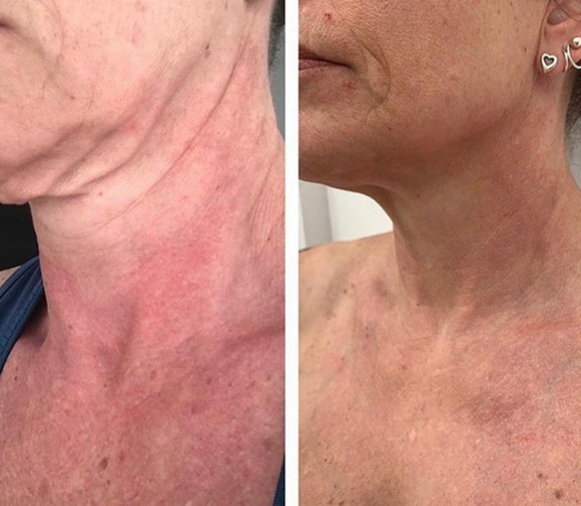 Radio-Frequency Skin Tightening - Top Notch Body Spa