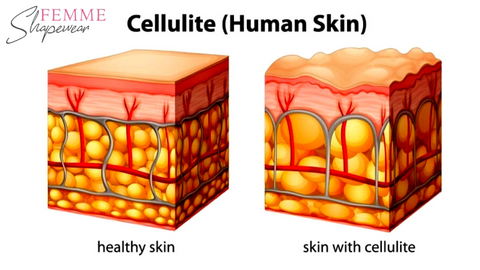 what is cellulite