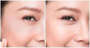 eye wrinkle patches