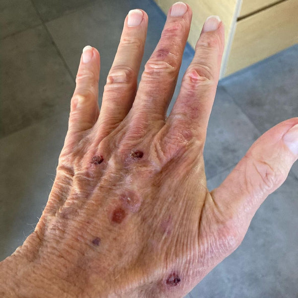Cell Carcinoma Diagnosed on Mark Richards’ Hand