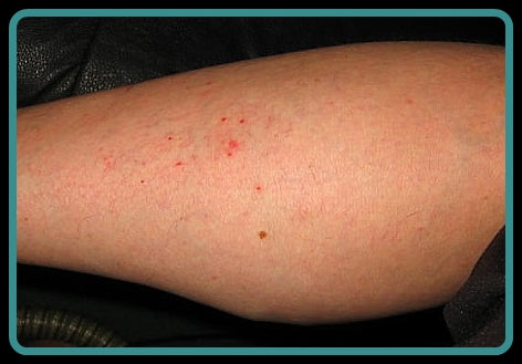 A picture of bird mite bites on a leg.