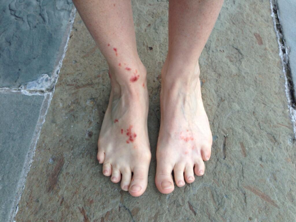 Picture of feet and legs with poison ivy rashes