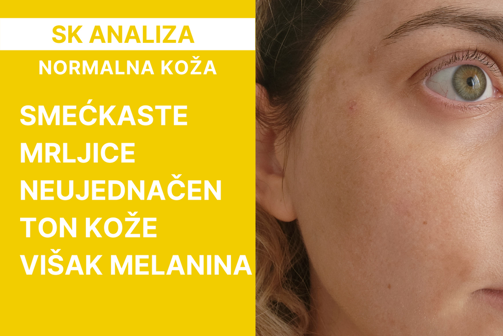 Analiza kože: hiperpigmentacije