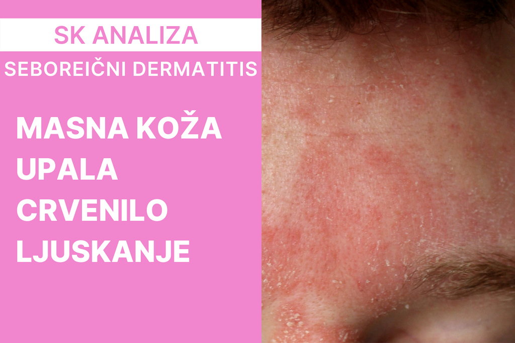 Seboreični dermatitis