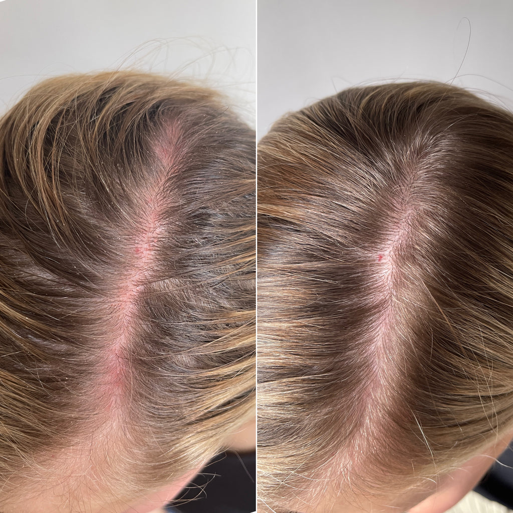 Sensitive scalp before and after