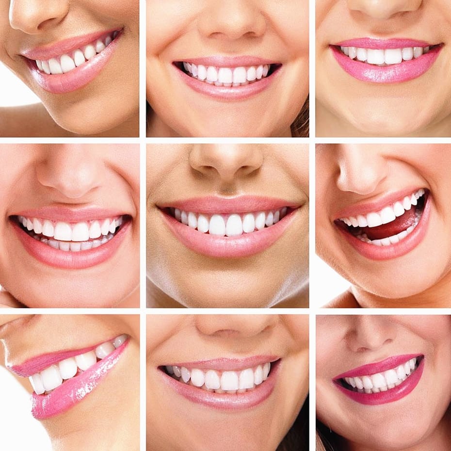 Trusteeth ™ LED Teeth Whitening Kit by Birmon