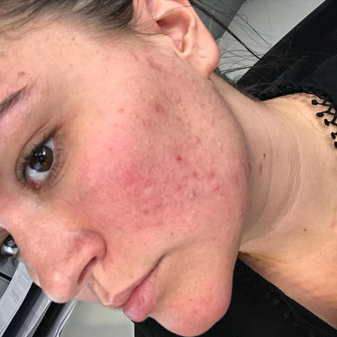 Cystic Acne cleanbeautybyjoy.com