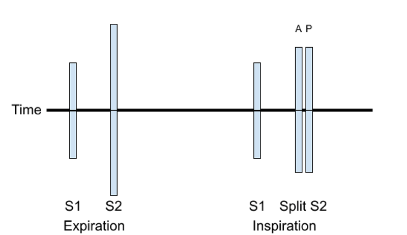 A depiction comparing a normal heart sound S1/S2 to a split S2; aortic, pulmonic