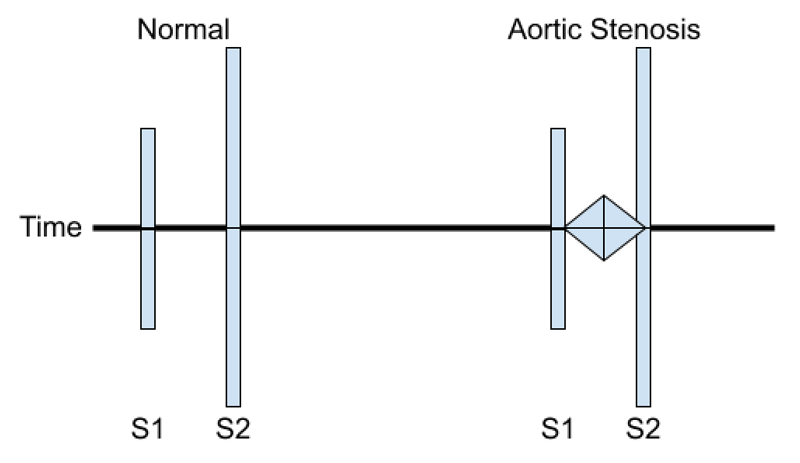 Upper panel - A depiction comparing a normal PCG to a PCG showing a systolic murmur between S1 and S2 (diamond).