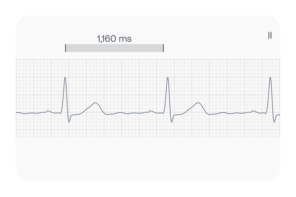 ECG showing Bradycardia is an arrhythmia defined by a slow heart rate