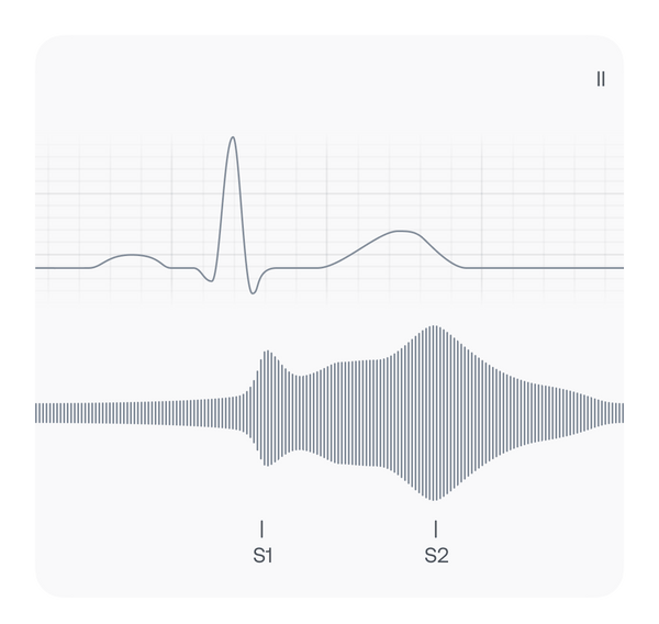 Patent Ductus Arteriosus PCG and ECG