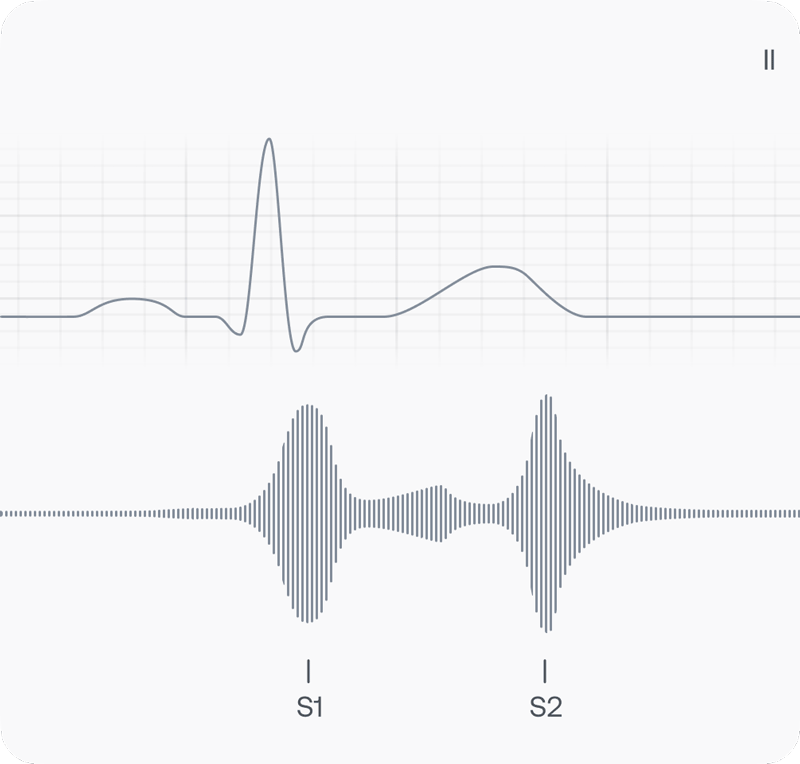 Visual representation of a Still's murmur recording