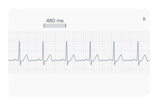 Showing an ECG with Tachycardia an arrhythmia defined by a fast heart rate, which is greater than 100 beats per minute (BPM) in adults