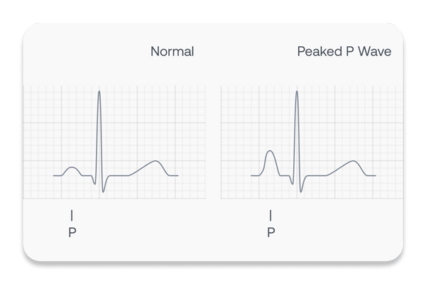 Graphic representing an ECG showing a peaked p-wave