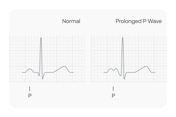 Graphical representation of an ECG showing a prolonged P Wave