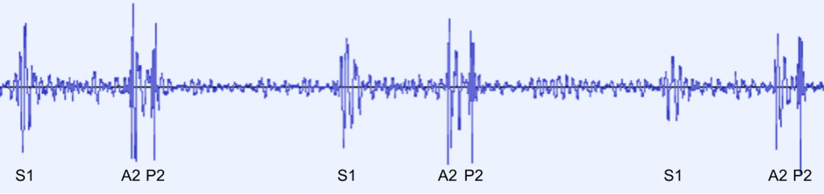 PCG showing the second heart sound (S2) splitting into separate aortic (A2) and pulmonic (P2) sounds. The first heart sound (S1) is not split.