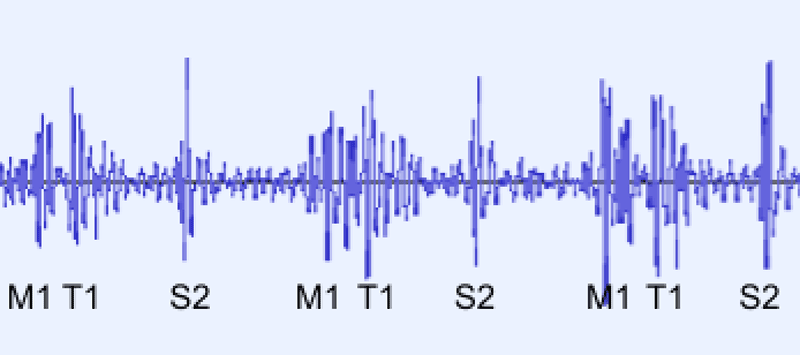 Lower Panel: A PCG showing the first heart sound (S1) splitting into separate mitral (M1) and tricuspid (T1) sounds. The second heart sound (S2) is not split.