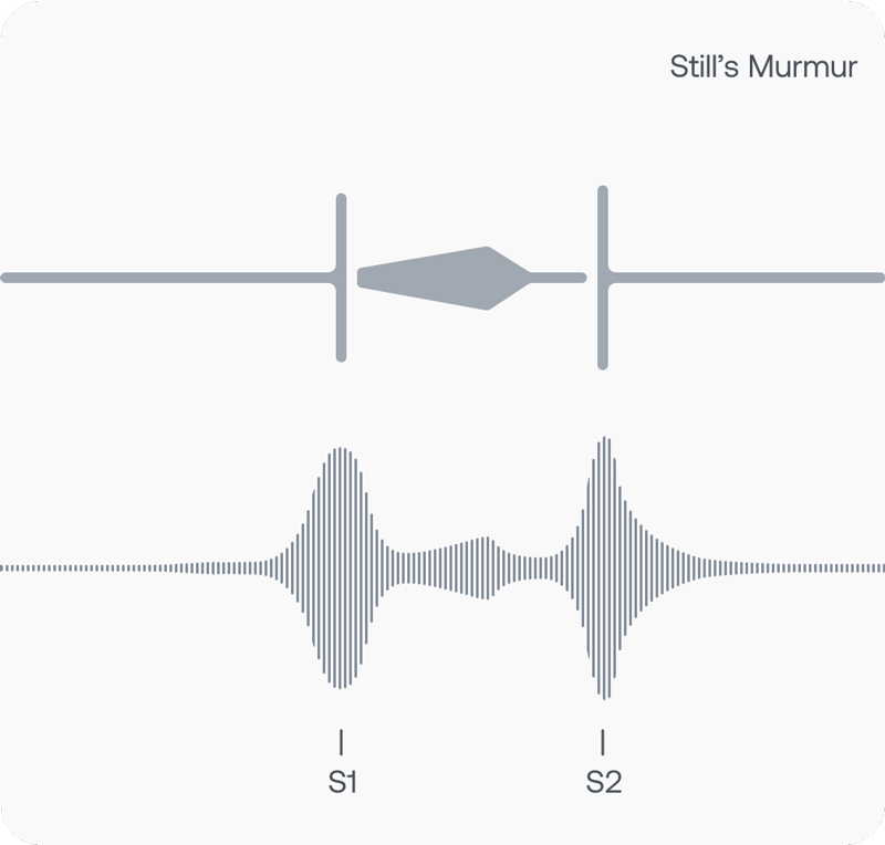 Visual representation of a Still's murmur recording