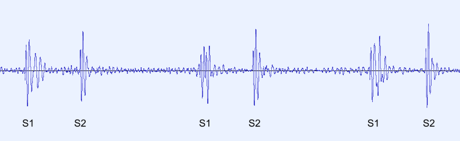 Phonocardiogram (PCG)