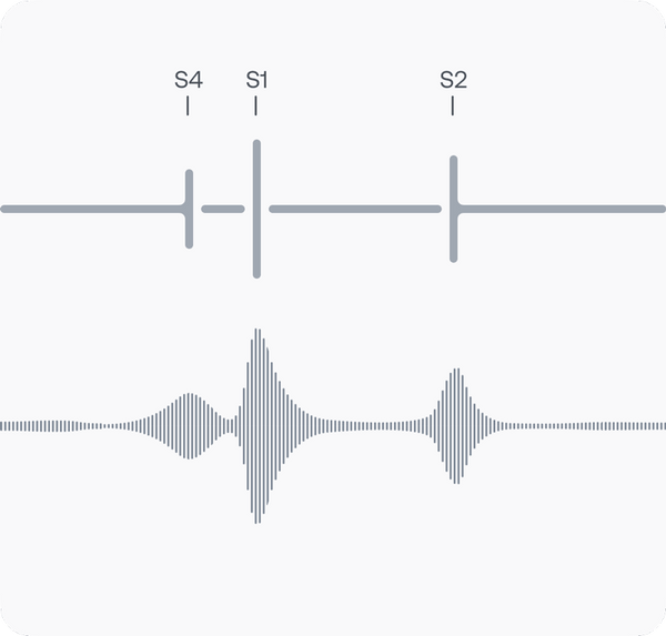 Graphical representation of a PCG of a normal sinus rhythm