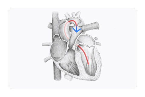 Drawing of Patent Ductus Arteriosus