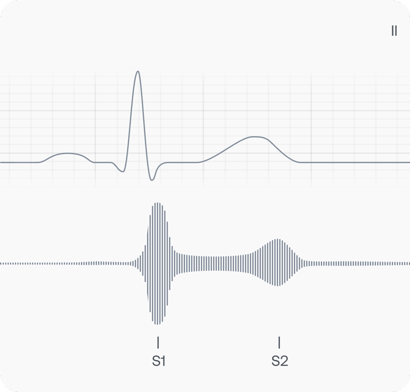 Showing ECG with normally no clear signs of TR on ECG