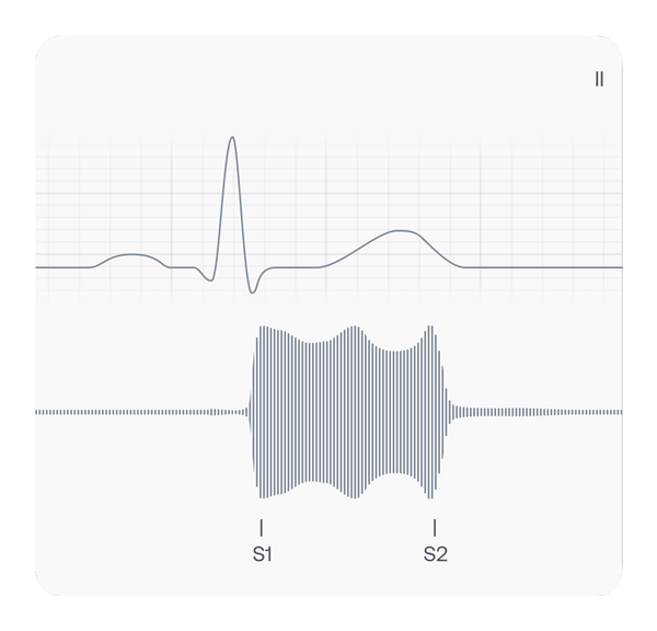 ECG and PCG showing VSD