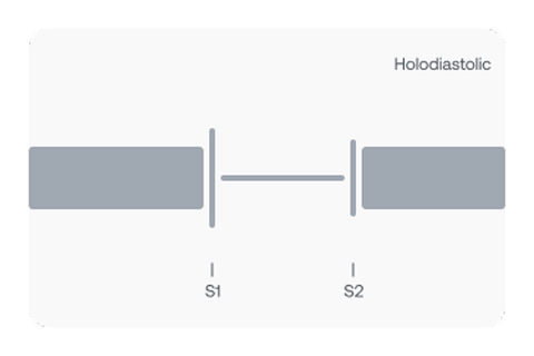 Graphical representation of a holodiastolic murmur is audible for the entire duration of diastole with an almost constant intensity.