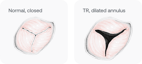 Drawing of normal and abnormal tricuspid valve