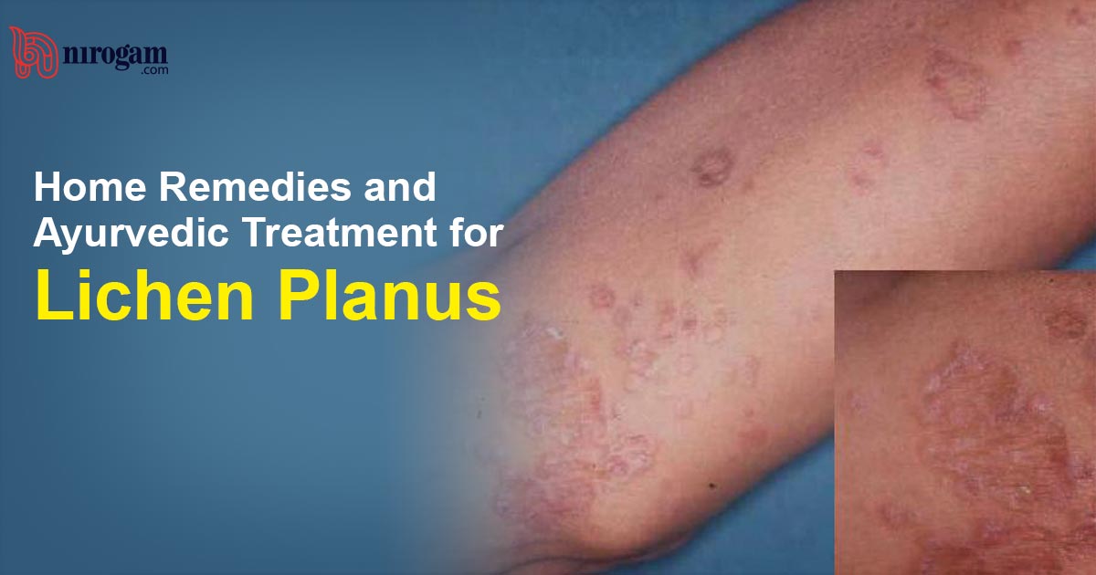 Home Remedies And Ayurvedic Treatment For Lichen Planus
