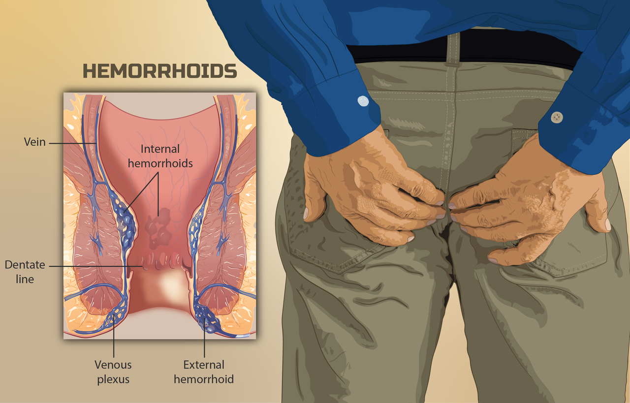 5 Effective Home Remedies for Piles Treatment – Nirogam