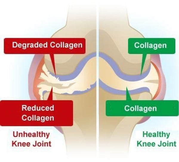 Joint pain symptom of collagen deficiency