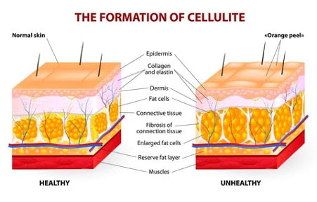 Formation of cellulite because of collagen deficiency