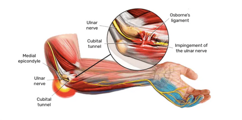 Cubital Tunnel Syndrom