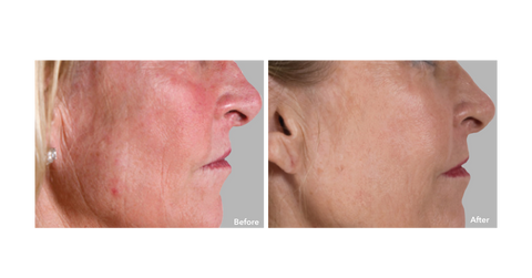 AnteAGE MD System - Wrinkles -  Before & After
