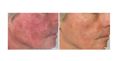 AnteAGE Serum before & after treatment